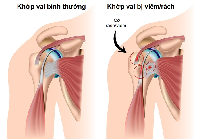 Viêm bao hoạt dịch khớp vai