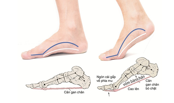 Khi bị viêm cân gan chân người bệnh thường thấy đau nhói ở vùng gót chân, vòm châm, đi lại khó khăn trên nền cứng (Ảnh minh họa)