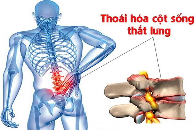 Thoái hóa cột sống lưng khiến người bệnh thường xuyên chịu đựng những cơn đau nhức