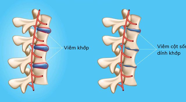 Có một số loại viêm khớp có thể làm ảnh hưởng tới các khớp cột sống cổ và gây ra triệu chứng đau sau gáy cổ (Ảnh minh họa)