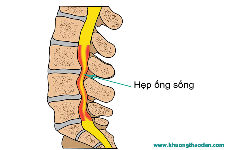 hep-ong-song-gay-te-moi