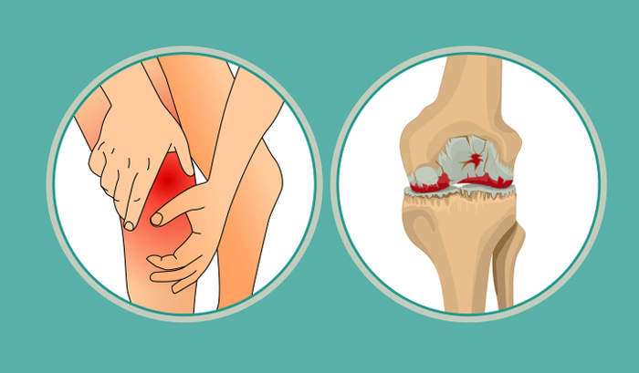 Sụn khớp bị hao mòn dần đi theo thời gian làm các đầu xương cọ vào nhau, gây ra những cơn đau nhức xương khớp về đêm (Ảnh minh họa)