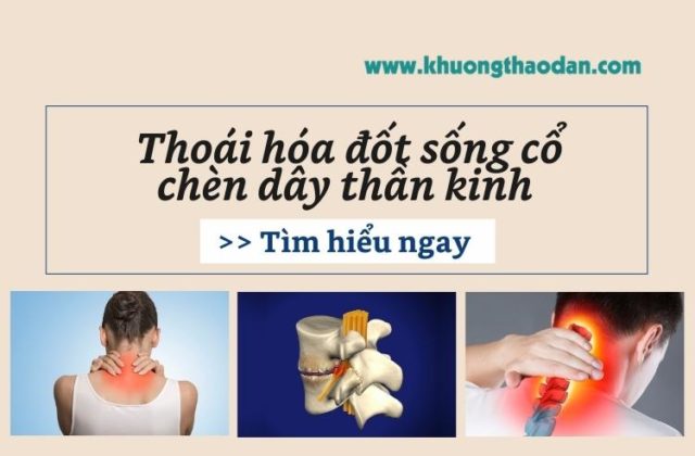 Thoái hóa đốt sống cổ chèn dây thần kinh (Ảnh minh hoạ)