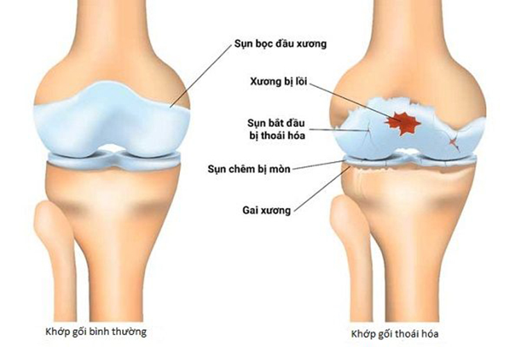 Hình ảnh minh họa cho bệnh lý thoái hóa khớp gối