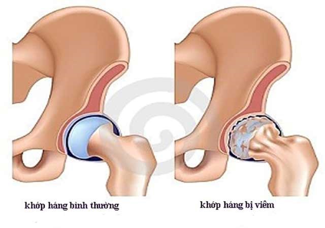 Dấu hiệu viêm khớp háng rất đa dạng